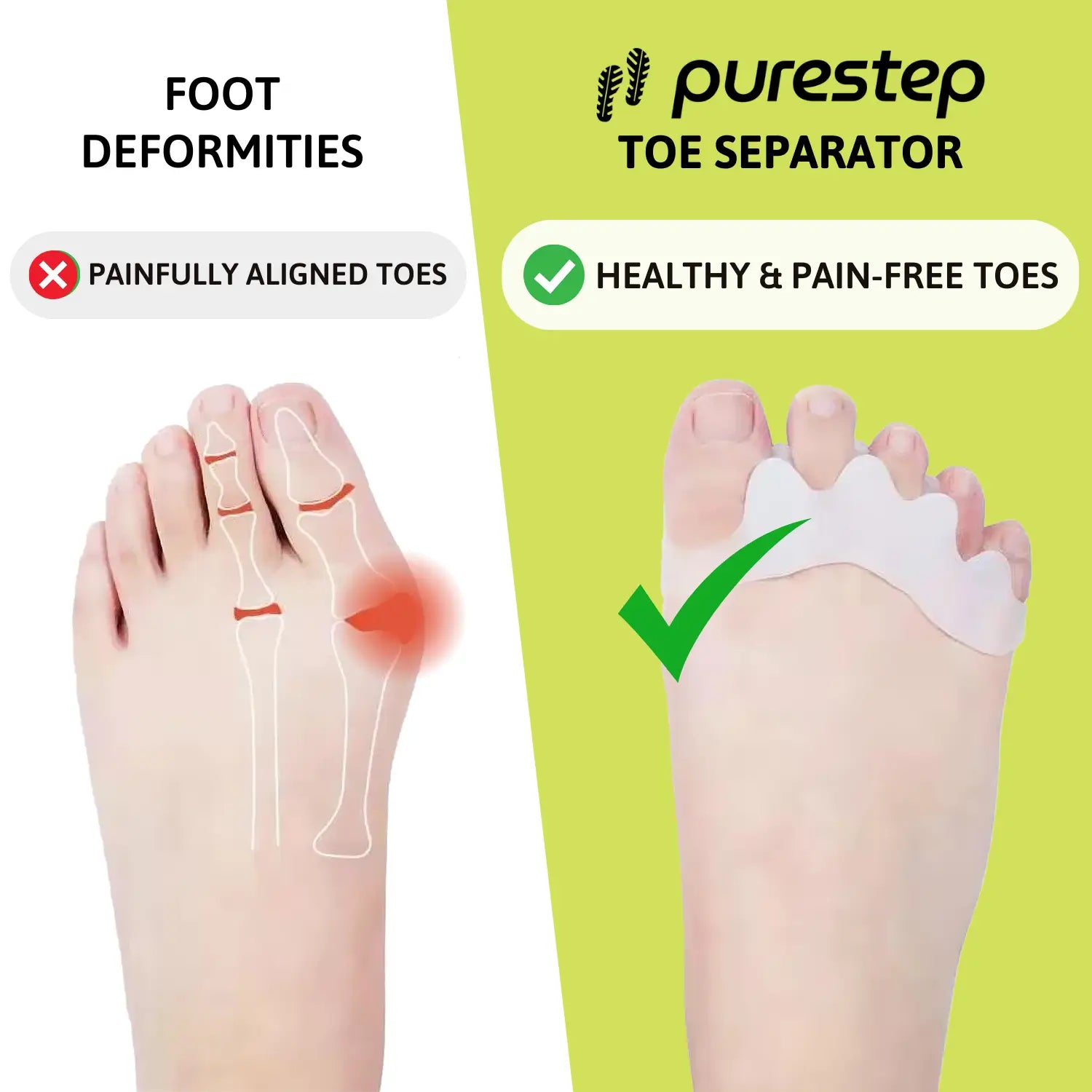 Toe Separator - Promotes Healthy Toes & Relieves Foot Pain