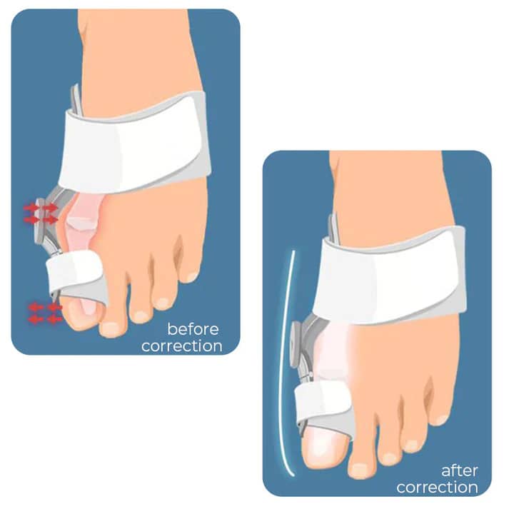 Hallux Valgus Bunion Corrector Purestep